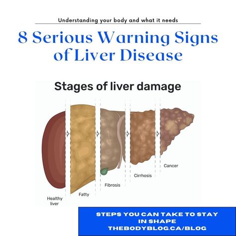 Pitting Edema, Quadrants Of The Abdomen, Enlarged Liver, Referred Pain, Get Enough Sleep, Liver Diet, Liver Failure, Healthy Lifestyle Quotes, Decrease Inflammation