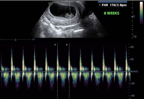 They meet when he's deep in the game wanting nothing but to breath wi… #fanfiction Fanfiction #amreading #books #wattpad Baby Heart Rate Gender Prediction, Fetal Heart Rate Gender, Heartbeat Gender Prediction, Baby Heart Rate Gender, Ultrasound Gender Prediction, Baby Heart Beat, Boy Or Girl Prediction, Gender Prediction Chart, Ultrasound Gender