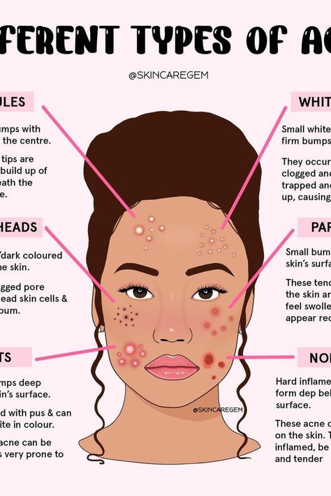 Types Of Pimples, Ways To Remove Blackheads, Acne Aesthetic, Esthetician Student, Natural Remedies For Acne, Pimple Extraction, Combination Skin Care Routine, Blind Pimple, Emotional Eater