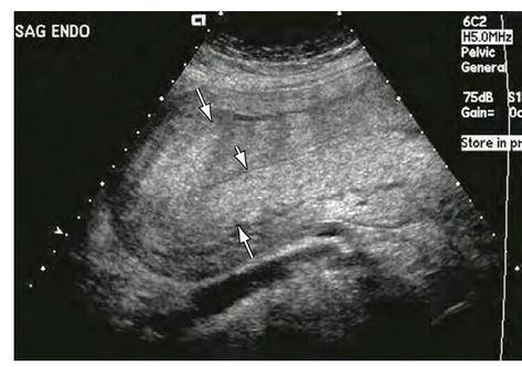 Ovarian Torsion, Medical Sonography, Mri Brain, Medical Ultrasound, Diagnostic Medical Sonography, Delivering A Baby, Scrub Life, Radiology, Ultrasound