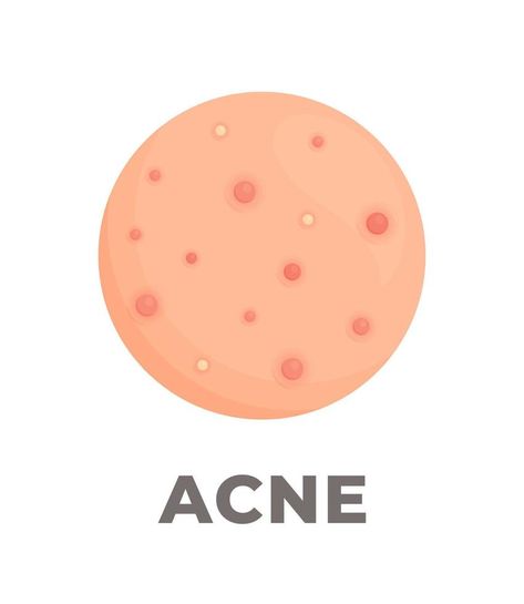 The consequences of poor skin care. Vector illustration of inflamed pimples on the skin. Acne. Dermatological disease. Acne Illustration Art, Acne Illustration, Closed Comedones, Inflamed Pimple, Different Types Of Acne, Stubborn Acne, Pimples Under The Skin, Fresh Aloe Vera Gel, Pimples Remedies