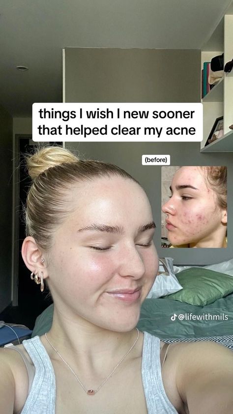 Clear your acne | get rid of acne Cheek Acne, Hormonal Acne Diet, Back Acne Remedies, Clear Skin Diet, Acne Diet, Skin Diet, Bad Acne, Acne Skincare, Get Rid Of Acne