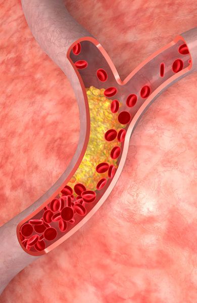 Angioplasty & Atherosclerosis Regime Anti Cholesterol, Tlc Diet, What Causes High Cholesterol, Low Cholesterol Diet, High Cholesterol Levels, Cholesterol Medications, Cholesterol Remedies, Cholesterol Lowering Foods, Lower Your Cholesterol