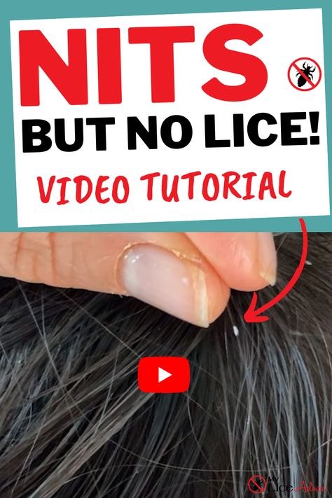 Lice And Nits Remedies, Best Way To Get Rid Of Lice And Nits, How To Remove Nits From Hair, How To Get Rid Of Lice Eggs, Getting Rid Of Lice Fast, Home Remedy For Lice And Nits, How To Get Rid Of Nits In Hair, Natural Remedies For Lice, How To Remove Lice Eggs From Hair