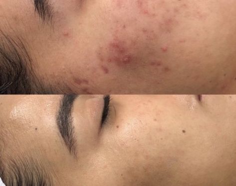 Esthetician Before And After, Before And After Microneedling, Skin Before After, Before And After Facial Pictures, Facials Before And After, Skin Before And After, Dermapen Before And After, Micronidelling Face, Microdermabrasion Before And After