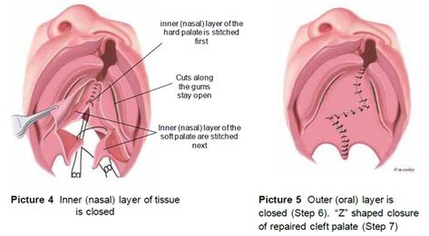 Cleft Palate Repair: The Surgery Cleft Lip And Palate, Cleft Palate, Soft Palate, Cleft Lip, Medical Student Study, Nasal Passages, Speech Language Therapy, Medical Insurance, Medical Knowledge