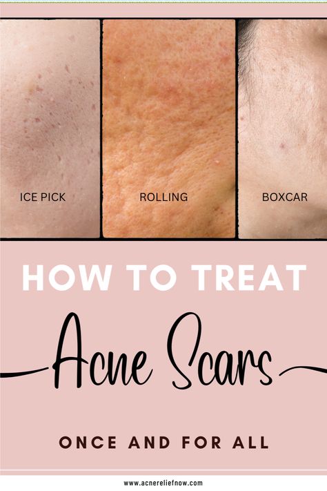 Natural ways to treat hormonal acne. How to manage hormonal acne. Learn what causes hormonal acne, ways to treat hormonal acne at home, hormonal acne tips, hormonal acne diet plan and treating hormonal acne naturally. Click the pin to get rid of hormonal acne for good. What Helps With Acne, Get Rid Of Hormonal Acne, Treat Hormonal Acne, Acne Diet Plan, Hormonal Acne Diet, Treating Cystic Acne, Hormonal Acne Remedies, Cystic Acne Remedies, Acne Tips