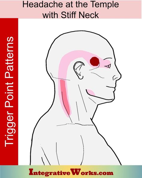 Headache At Your Temple with Stiff Neck - Integrative Works Temple Headache Relief, Temple Headache, Headache Chart, Trigger Points Neck, Neck Release, Neck Headache, Forward Head Posture Exercises, Sinus Congestion Relief, Throbbing Headache