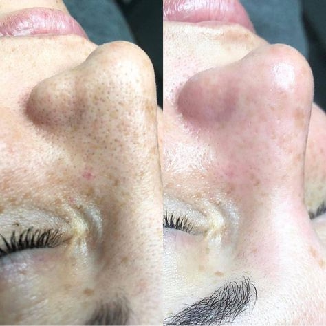 Good resulpt on blackhead removal! Hydrafacial Before And After, Facial Before And After, Diy Shampoo Recipe, Baking Soda For Hair, Baking Soda Benefits, Eyelid Lift, Mole Removal, Hydra Facial, Facial Aesthetics