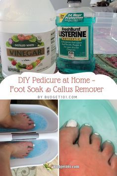 Callus Remover Diy, Homemade Pedicure, Diy Pedicure At Home, Home Foot Soak, At Home Pedicure, Homemade Foot Soaks, Pedicure Soak, Callous Remover, Listerine Foot Soak