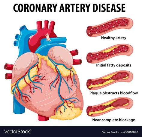 Foot Reflexology Massage, Coronary Artery, Angina Pectoris, Coronary Arteries, Heart Muscle, Educational Infographic, Healing Touch, Cardiology, Cardiovascular Disease