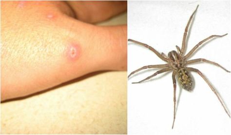 It can be hard to tell if and when you've been attacked by a bug. Knowing the source of your itchiness, pain, or weird bruising can help you treat it! Insect Bites Relief, Brown Recluse Spider Bite Pictures, Insect Bites Identification, Spider Bites Remedies, Brown Recluse Spider Bite Stages, Infected Bug Bite, Treating Spider Bites, Spider Bite Symptoms, Types Of Bug Bites