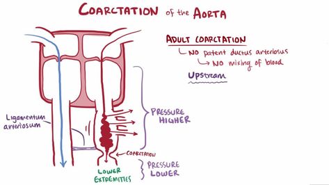 Image result for coarctation of the aorta Coarctation Of The Aorta, Child Health, Lower Extremity, Adrenal Glands, Brittle Nails, Cardiovascular System, Nursing Student, Kids Health, Health Goals