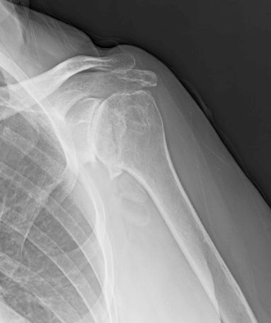 Shoulder and Elbow Surgery: Walch A2 glenoids in degenerative shoulder arthrit... Shoulder Instability, Rotator Cuff Stretches, Rotator Cuff Strengthening, Humerus Fracture, Bursitis Shoulder, Shoulder Range Of Motion, Elbow Surgery, Shoulder Dislocation, Physical Therapy Exercises