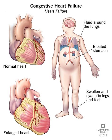 Best Cough Remedy, Alcohol Use Disorder, Chronic Cough, Cleveland Clinic, School Of Medicine, Mole, Disease