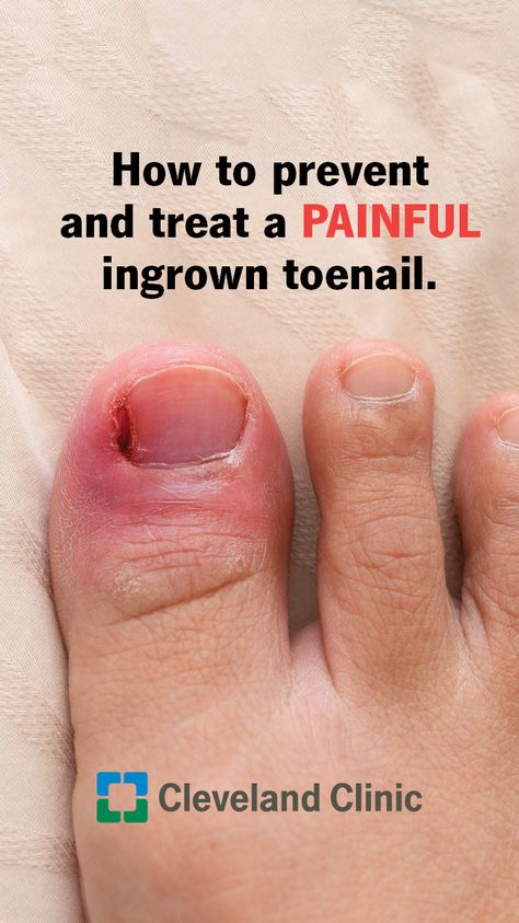 Toenail Pain, Infected Toenail, Toenail Removal, Toenail Fungal Infection, Nail Remedies, Toenail Fungus Remedies, Ingrown Toenail, Nail Infection, Ingrown Nail