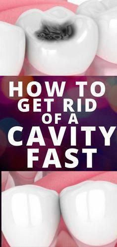 How you can reverse cavities naturally without drilling into your teeth and filling them with synthetic materials? #TakeCareOfOralHealth #NaturalOralCare #WhatDoesOralCareMean #WhatIsMeaningOfOralCare Tooth Scaling, Reverse Cavities Naturally, Cavity Remedy, Baby Bottle Tooth Decay, Reverse Cavities, Best Mouthwash, Tooth Decay Remedies, Plaque Removal, Stronger Teeth