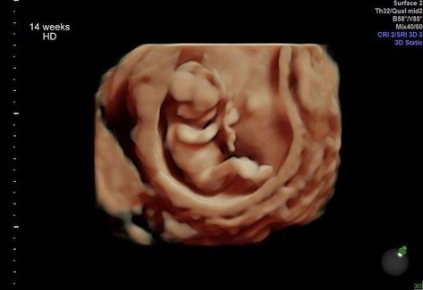 4d ultrasound images Ultra Sound, Video Effect, 3d Ultrasound, 4d Ultrasound, 3d Color, Gender Reveals, Video Effects, Ultrasound, Images Gif