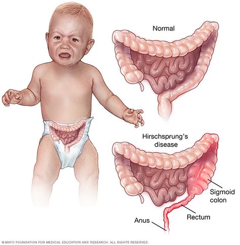 General Medicine, Reflux Remedies, Failure To Thrive, Pediatric Surgery, Chronic Constipation, Neonatal Nurse, Disease Symptoms, Nursing Tips, Nicu Nurse