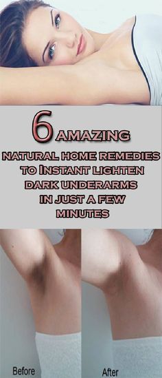 Friends here I will tell you some easy and effective home remedies to get rid of dark underarms fast. You can get rid of dark underarm in a few days by using these ingredients. Dark Armpits, Unwanted Hair Growth, Underarm Odor, Underarm Hair Removal, Dark Underarms, Beauty Tips For Glowing Skin, Unwanted Hair Removal, Unwanted Hair, Beauty Skin Care Routine