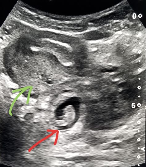 #Ultrasound, #pregnant woman, shows a #fetus growing dangerously outside the uterus (#ectopic). Green: #Uterus. Ob Ultrasound, Sonography Student, Medical Sonography, Diagnostic Medical Sonography, Mri Scan, Pregnant Woman, Radiology, Ultrasound, Dream Job