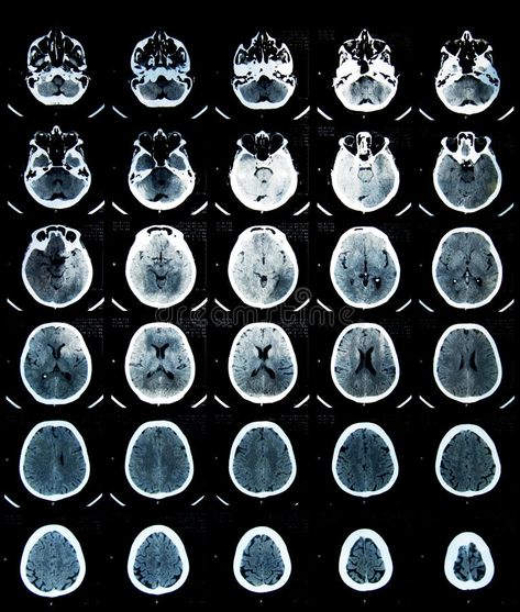 Head Ct Scan Aesthetic, Brain Tumour Fake Report, Ct Scan Brain, Ct Brain, Brain Surgeon, Short Notes, Art Alevel, Brain Anatomy, Brain Scan