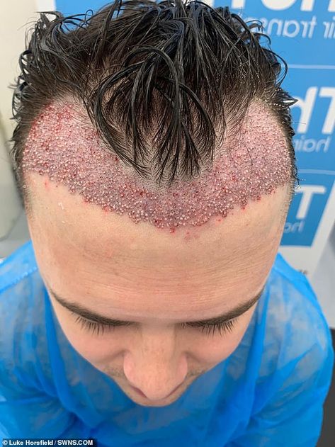 Luke Horsfield left with severe scarring after £1,250 botched hair transplant surgery It Technician, Thinning Hairline, Hair Transplant Cost, Bald Patches, Hair Transplant Surgery, Hair Growth Cycle, Regrow Hair, Scarring, Grow Hair Faster