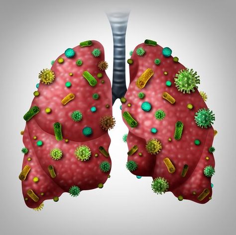 Read about a study reporting that Synspira’s SNSP113 gives antibiotics more punch against a bacteria often seen in cystic fibrosis patients. Pneumonia Causes, Increase Lung Capacity, Streptococcus Pneumoniae, Lung Detox, Human Lungs, Lung Infection, Lungs Health, Nasal Congestion, Juicing For Health