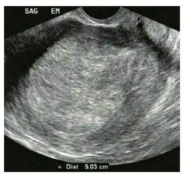 Endometrial carcinoma. Sagittal transvaginal view of the uterus in a postmenopausal woman demonstrates a markedly thickened endometrium, measuring 5.03 cm (calipers). Biopsy revealed endometrial carcinoma Endometrial Carcinoma, Diagnostic Medical Sonography, Ultrasound, Calipers, Medical, Abstract Artwork