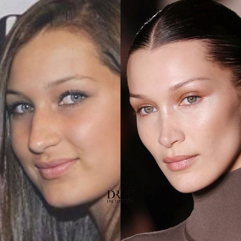 Bella Hadid Nose Job Before And After, Celebrities Before And After Surgery, Flat Cheekbones, Nose Job Aesthetic, Nose Job Before And After, Bella Hadid Nose, Celebrity Nose Jobs, Nose Filler, Ethnic Rhinoplasty