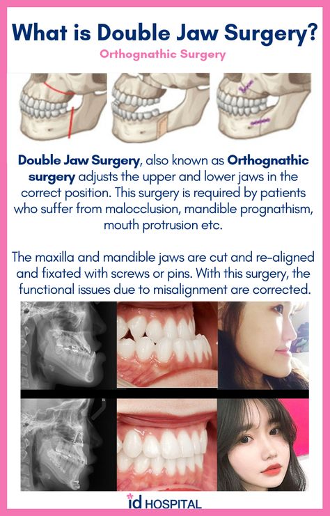 Many patients think they need double jaw surgery to get a smaller face! Orthognathic surgery is more of a functionality surgery. ID Hospital specializes in orthognathic surgeries and facial bone surgeries. Click here to find out more about this surgery! #idhospital #idhospitalkorea #plasticsurgery #koreanplasticsurgery #surgeryinkorea #facialcontouring #orthognathicsurgery #doublejawsurgery #malocclusion #mouthprotrusion #underbite #overbite #crossbite Jaw Surgery Before And After Overbite, Orthognathic Surgery Before And After, Double Jaw Surgery Before And After, Jaw Surgery Before And After, Jaw Surgery Recovery, Corrective Jaw Surgery, Double Jaw Surgery, Surgery Care Package, Mouth Hygiene