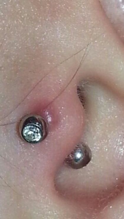 A Comprehensive Guide To Piercing Bumps Infected Ear Piercing, Piercing Bump, Hypertrophic Scars, Ear Peircings, Tragus Piercings, Ear Piercing, Tree Oil, Tea Tree Oil, Tragus