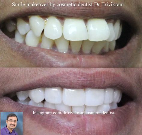 DO NOT HIDE YOUR SMILE ANYMORE ! NO BRACES SMILE MAKEOVERS In 2 WEEKS BY COSMETIC DENTIST DR TRIVIKRAM HAVE ENHANCED THOUSANDS. OF SMILES FOR THE LAST 20 YEARS . Skilfully blending science and art, Dr Trivikram #drtrivikram with #porcelainveneers can “sculpt” a more attractive smile for you in just 3-4 visits in 7-10 days without braces. For consultation 🦷😁 check out the WEBLINK IN BIO on profile.#smilemakeover #porcelaincrowns Attractive Smile, Braces Smile, Porcelain Crowns, Dentist Doctor, Porcelain Veneers, Dental Center, Smile Makeover, Your Smile, All Smiles