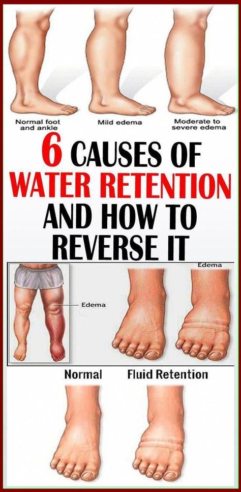 6 Ways To Reduce Water Retention Fluid Retention Remedies, Bad Circulation, Reduce Water Retention, Water Retention Remedies, Summer Health, Fluid Retention, Water Retention, Healthy Beauty, Good Health Tips