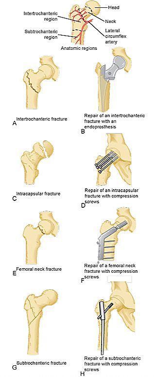 Orthopedic Nursing, Surgical Technician, Radiology Student, Hip Fracture, Surgical Technologist, Surgical Nursing, Medical School Essentials, Orthopedic Surgery, Medical Anatomy