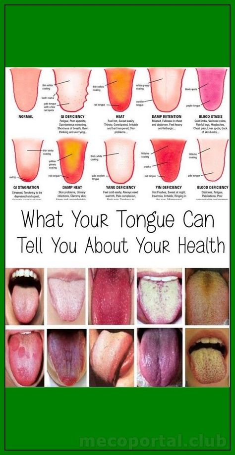 Healthy Tongue, Cheezburger Funny, Fortnite Tiktok, Inner Health, Canker Sore, Tongue Health, Aesthetic Inspiration, Photography Aesthetic, Nail Health