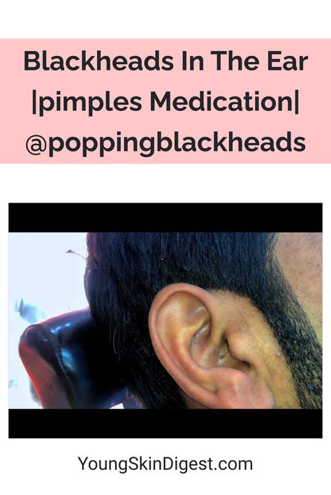 Blackheads In The Ear |pimples Medication| @poppingblackheads Pimples In Ear, Ear Blackheads, Black Head Removal Video Nose, Pimple Hacks, Blackheads On Back, Acne Recipes, Huge Blackheads, Head Pimples, Ear Pimple