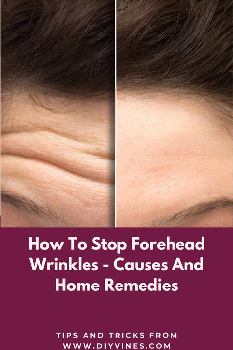 Get Rid Of Deep Forehead Wrinkles, How To Stop Forehead Wrinkles, How To Remove Wrinkles On Forehead, Dry Forehead, Natural Wrinkle Remedies, Home Remedies For Wrinkles, Anti Aging Remedies, Lotion For Oily Skin, Wrinkle Remedies