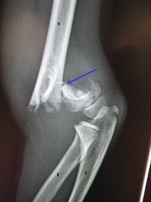 Humerus Fracture, Open Fracture, Radial Nerve, Ulnar Nerve, Normal Values, X-ray Images, Median Nerve, Bicep Muscle