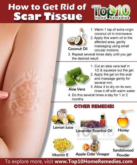 How to Get Rid of Scar Tissue | Top 10 Home Remedies Acne Face Mask Homemade, Coconut Oil Massage, Getting Rid Of Scars, Scar Removal Cream, Acne Scar Removal, Face Acne, Scar Removal, Scar Tissue, Aloe Vera Leaf