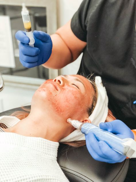 PRP Microneedling Prp Microneedling, Best Sheet Masks, Vampire Facial, Platelet Rich Plasma, Red Blood, Derma Roller, Red Blood Cells, Best Moisturizer, Wear Sunscreen