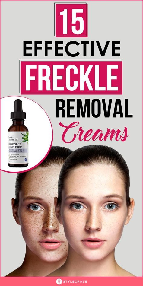 15 Effective Freckle Removal Creams #freckle #beauty #beautyhacks Freckle Remover Before And After, Get Rid Of Freckles On Face, How To Get Rid Of Freckles Naturally, How To Remove Freckles, How To Get Rid Of Freckles On Face, Freckles Remover Homemade, How To Get Rid Of Freckles, How To Remove Freckles From Face, Remove Freckles From Face