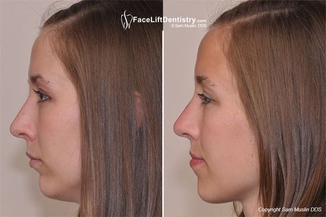 What is Face Lift Dentistry Overbite Before And After, Overbite Correction, Fix Overbite, Small Chin, Corrective Jaw Surgery, Dry Hand Skin, Chin Augmentation, Botox Before And After, Jaw Surgery