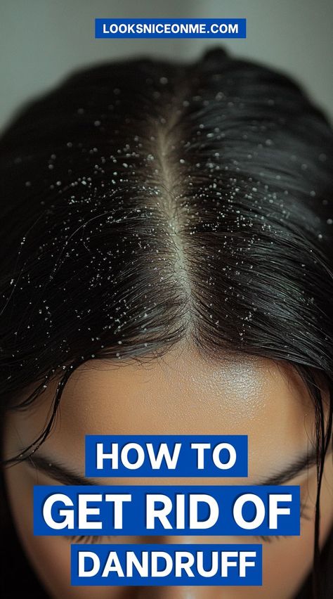 Struggling with dandruff? Find effective tips for tackling dandruff with DIY treatments, anti-dandruff shampoos, and healthy scalp habits. Say goodbye to flakes for good! #DandruffFree #HealthyScalp #HairCareRoutine How To Get Rid Of Dandruff Fast At Home, Dandruff Remedy Severe, Bad Dandruff, Hair Mask For Dandruff, Home Remedies For Dandruff, Oils For Dandruff, Rid Of Dandruff, Winter Hair Care, Dandruff Remedy