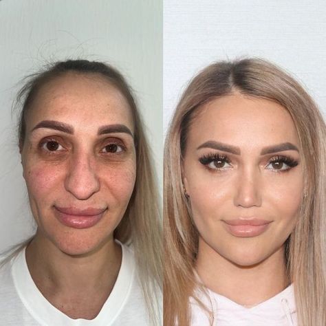 Woman's surgery makeover so dramatic people say she 'needs a new passport' Dramatic People, Kpop Plastic Surgery, Jaw Reduction Surgery, V Line Surgery, Body Contouring Surgery, Plastic Surgery Fail, Korean Plastic Surgery, Plastic Surgery Gone Wrong, Face Surgery