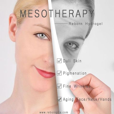 Mesotherapy Face, Face Scar, Anti Aging Hands, Derma Pen, Skin Pigmentation, Fine Wrinkles, Aging Face, Scar Removal, Medical Aesthetic