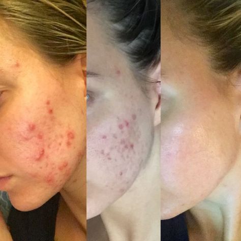 image Before And After Acne, Redness Pimple, Clear Skin Fast, Forehead Acne, Skin Care Pictures, Natural Acne Remedies, Cystic Acne, Acne Remedies, Skin Care Solutions