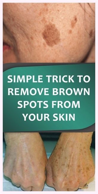 Super-duper fact! Age Spot Removal, Dark Spots On Face, Brown Spots Removal, Brown Spots On Face, Skin Spots, Spots On Face, Natural Cough Remedies, Makeup Looks For Brown Eyes, Smokey Eyes