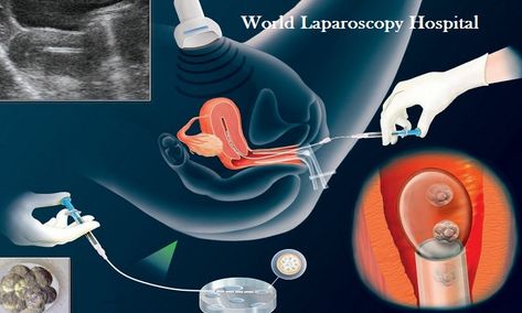 In Vitro Fertilization Process, Fertilization Process, Frozen Embryo Transfer, Egg Donor, Assisted Reproductive Technology, Sperm Donor, Egg Donation, Embryo Transfer, In Vitro Fertilization