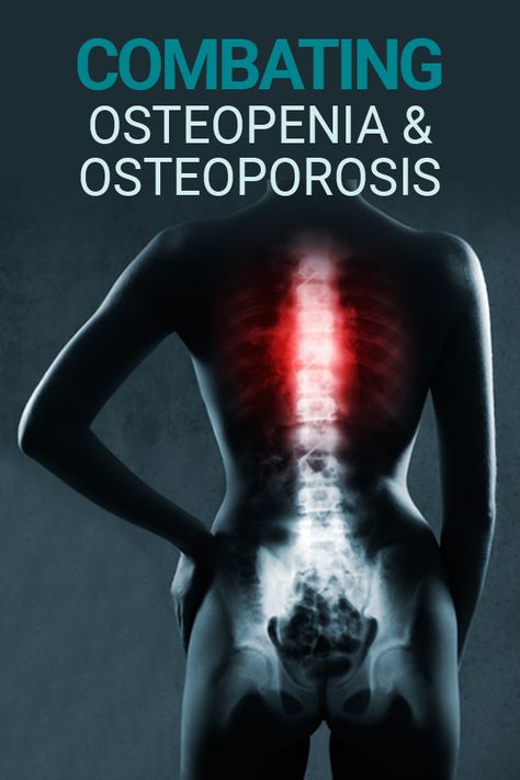 Bone Healing Foods, Osteoporosis Diet, Osteoporosis Exercises, Osteoporosis Prevention, Bone Healing, Increase Bone Density, Bone Diseases, Bone Loss, Bone Density